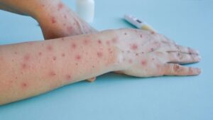 Wabah Mpox (Monkeypox) Menjadi Darurat Kesehatan Global