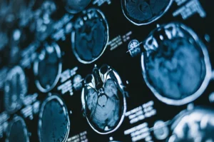 Penyakit Mental dan Neurologis: Panduan Lengkap Memahami Gangguan Otak dan Jiwa