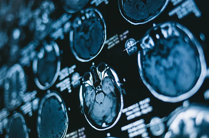 Penyakit Mental dan Neurologis: Panduan Lengkap Memahami Gangguan Otak dan Jiwa