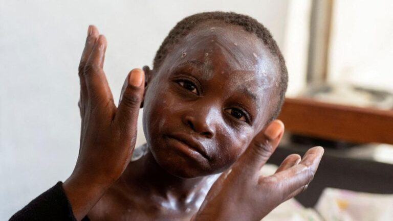 Wabah Mpox di Afrika: Krisis Kesehatan yang Meningkat Drastis